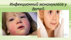 инфекционный мононуклеоз у детей 