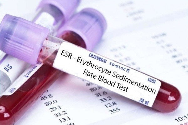 Можно ли по общему анализу крови определить есть ли пневмония thumbnail