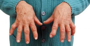 симптомы артрита у женщины