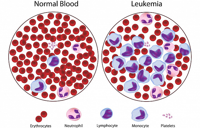 изображение нормальной крови и лейкемии под микроскопом