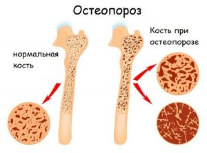 изменения в костях при остеопорозе